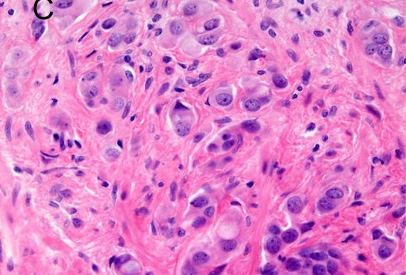 Prostate cancer cells.